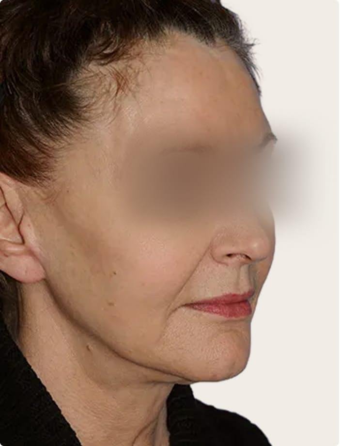 Aesthetic Facial Plastic Surgery – Dr. Philip Young MD after — Bellevue, WA