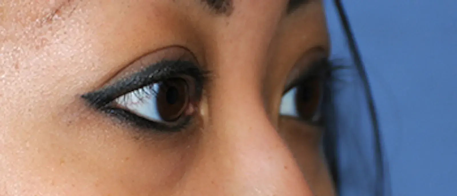 Aesthetic Facial Plastic Surgery – Dr. Philip Young MD eyelid lift after — Bellevue, WA