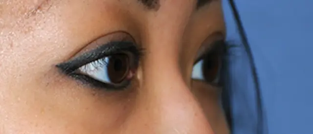 Blepharoplasty after at Aesthetic Facial Plastic Surgery – Dr. Philip Young MD in Bellevue, WA