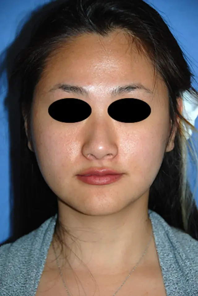 Chin Implant after at Aesthetic Facial Plastic Surgery – Dr. Philip Young MD in Bellevue, WA