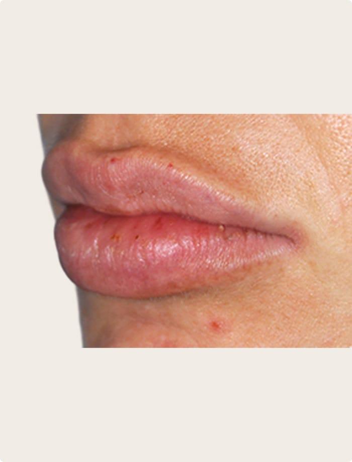 Aesthetic Facial Plastic Surgery – Dr. Philip Young MD after — Bellevue, WA