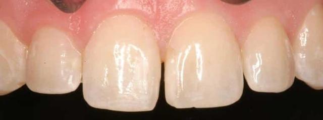 Dental Veneers before at Matt McGee Family and Cosmetic Dentistry in Nashville, TN