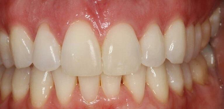 Matt McGee Family and Cosmetic Dentistry veneers after — Nashville, TN