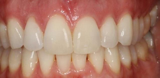 Dental Veneers after at Matt McGee Family and Cosmetic Dentistry in Nashville, TN