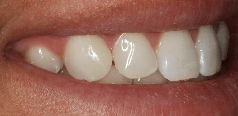 Matt McGee Family and Cosmetic Dentistry veneers after — Nashville, TN