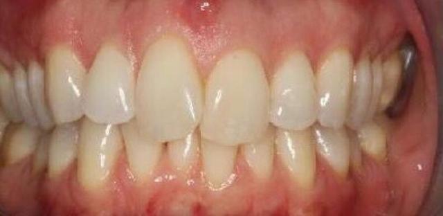 Dental Veneers before at Matt McGee Family and Cosmetic Dentistry in Nashville, TN