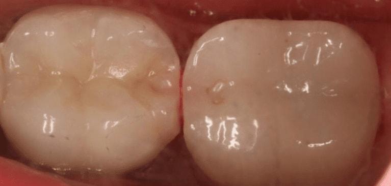 Matt McGee Family and Cosmetic Dentistry dental crowns after — Nashville, TN