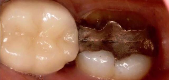 Dental Veneers before at Matt McGee Family and Cosmetic Dentistry in Nashville, TN