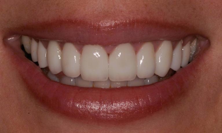 Matt McGee Family and Cosmetic Dentistry veneers after — Nashville, TN