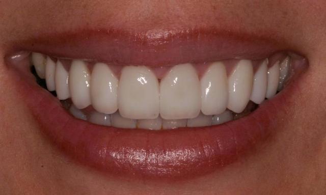 Dental Veneers after at Matt McGee Family and Cosmetic Dentistry in Nashville, TN