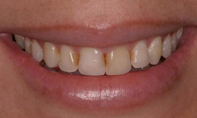 Dental Veneers before at Matt McGee Family and Cosmetic Dentistry in Nashville, TN