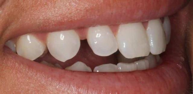Dental Veneers before at Matt McGee Family and Cosmetic Dentistry in Nashville, TN