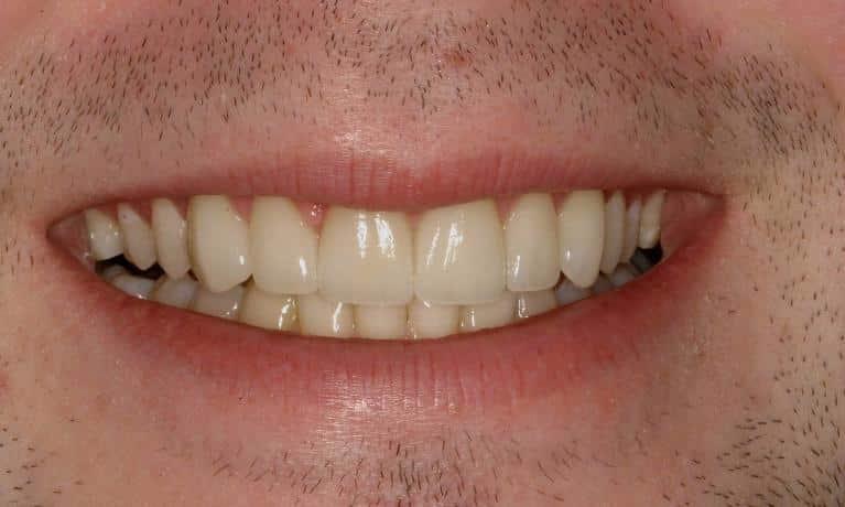 Matt McGee Family and Cosmetic Dentistry veneers after — Nashville, TN