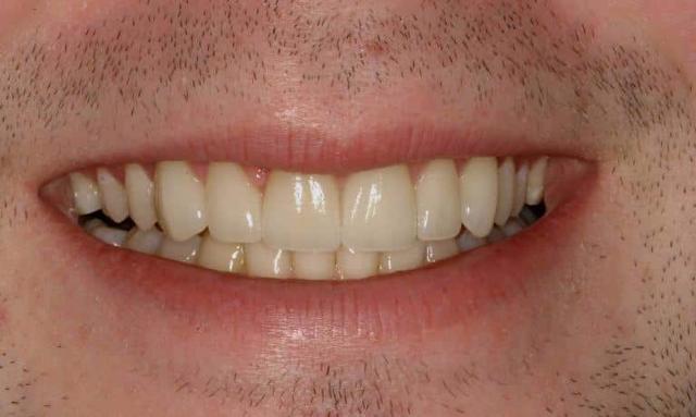 Dental Veneers after at Matt McGee Family and Cosmetic Dentistry in Nashville, TN