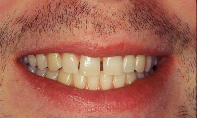 Dental Veneers before at Matt McGee Family and Cosmetic Dentistry in Nashville, TN