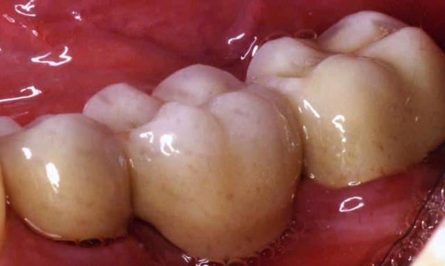 Smile Makeover after at Matt McGee Family and Cosmetic Dentistry in Nashville, TN