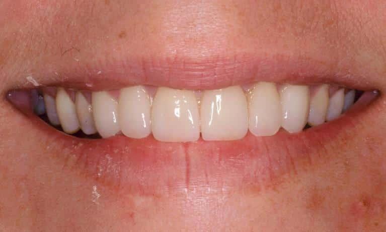 Matt McGee Family and Cosmetic Dentistry veneers after — Nashville, TN
