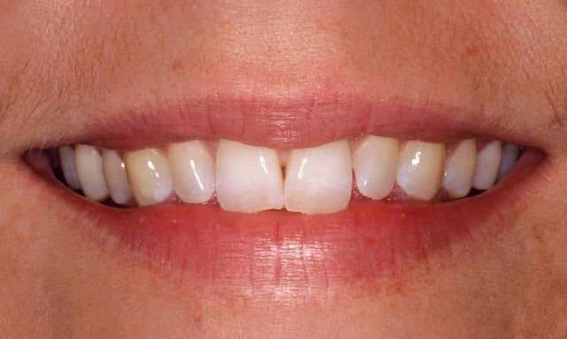 Dental Veneers before at Matt McGee Family and Cosmetic Dentistry in Nashville, TN