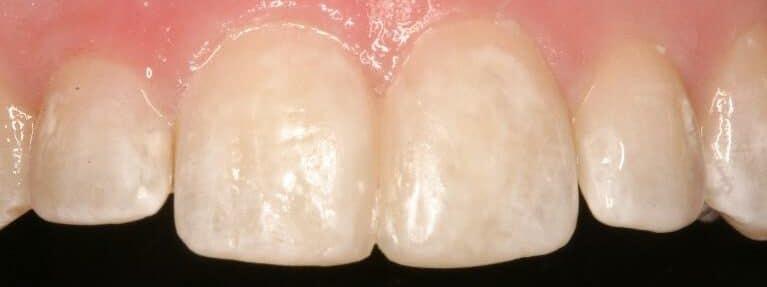 Matt McGee Family and Cosmetic Dentistry dental bonding after — Nashville, TN