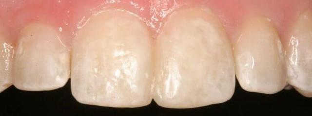 Dental Veneers after at Matt McGee Family and Cosmetic Dentistry in Nashville, TN