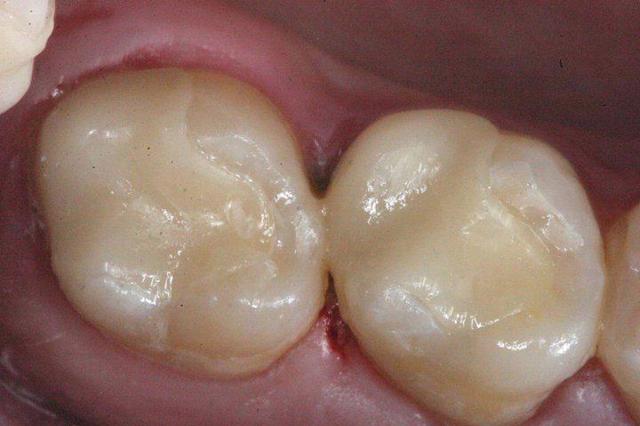 Smile Makeover after at Matt McGee Family and Cosmetic Dentistry in Nashville, TN