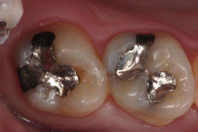 Smile Makeover before at Matt McGee Family and Cosmetic Dentistry in Nashville, TN