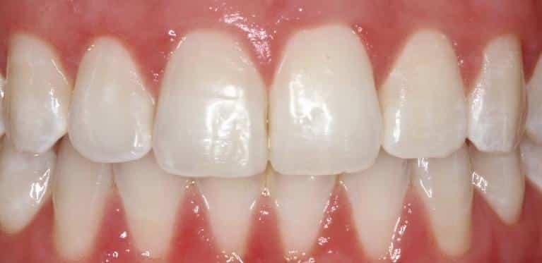 Matt McGee Family and Cosmetic Dentistry dental bonding after — Nashville, TN