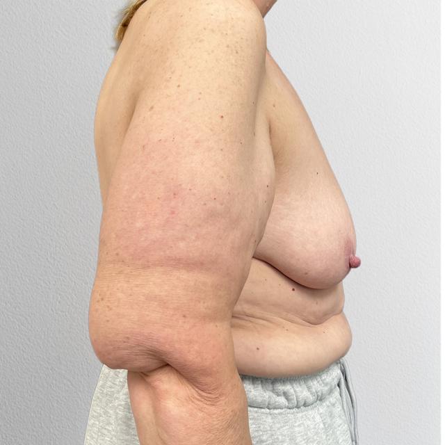 Breast Lift before at Alpine Plastic Surgery in Ogden, UT