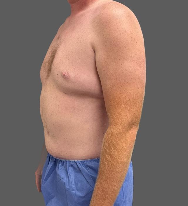 Gynecomastia Surgery after at Alpine Plastic Surgery in Ogden, UT