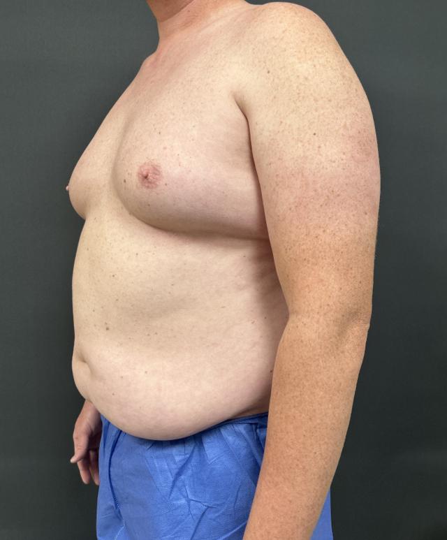 Gynecomastia Surgery before at Alpine Plastic Surgery in Ogden, UT