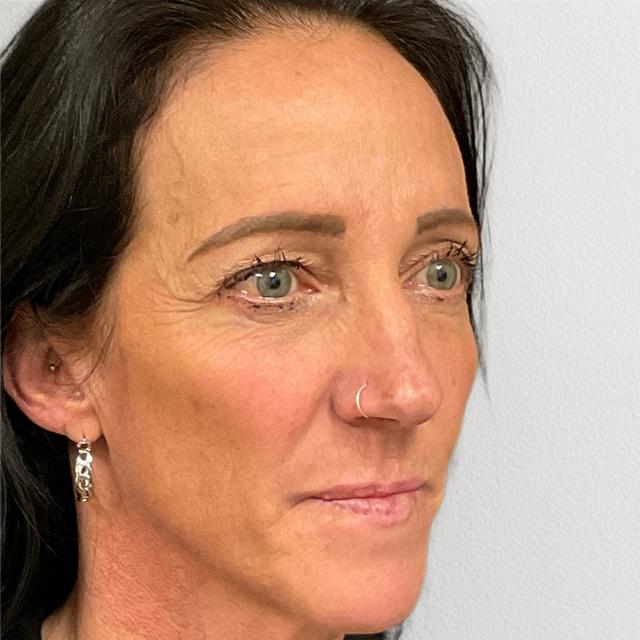 Brow Lift before at Alpine Plastic Surgery in Ogden, UT