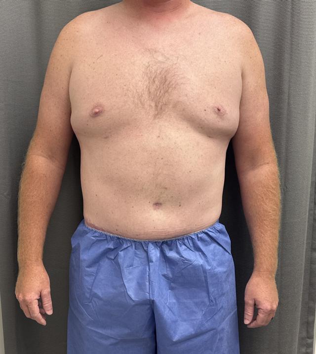 Gynecomastia Surgery after at Alpine Plastic Surgery in Ogden, UT