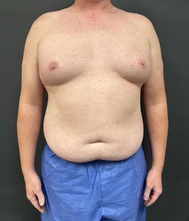 Gynecomastia Surgery before at Alpine Plastic Surgery in Ogden, UT