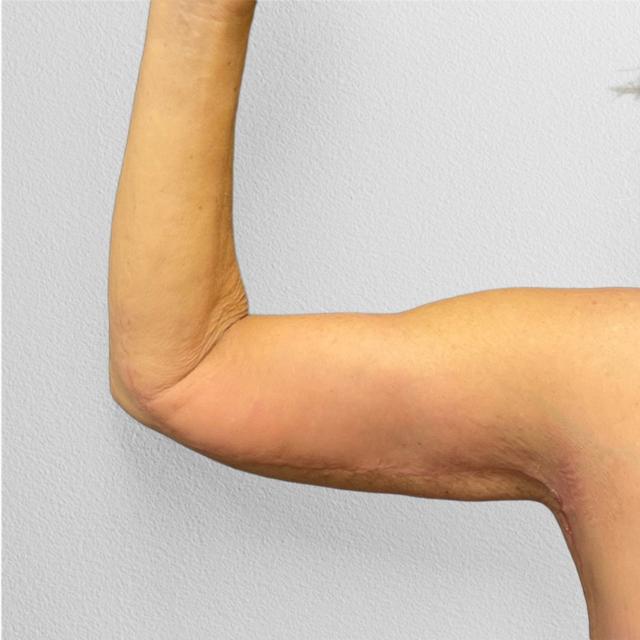 Arm Lift after at Alpine Plastic Surgery in Ogden, UT