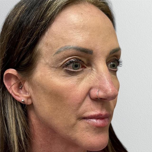 Brow Lift after at Alpine Plastic Surgery in Ogden, UT
