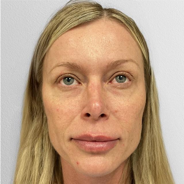 Ethnic Rhinoplasty before at Alpine Plastic Surgery in Ogden, UT