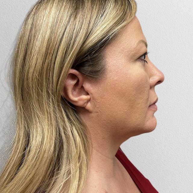 Neck Liposuction after at Alpine Plastic Surgery in Ogden, UT