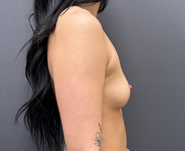 Fat Transfer Breast Augmentation before at Alpine Plastic Surgery in Ogden, UT