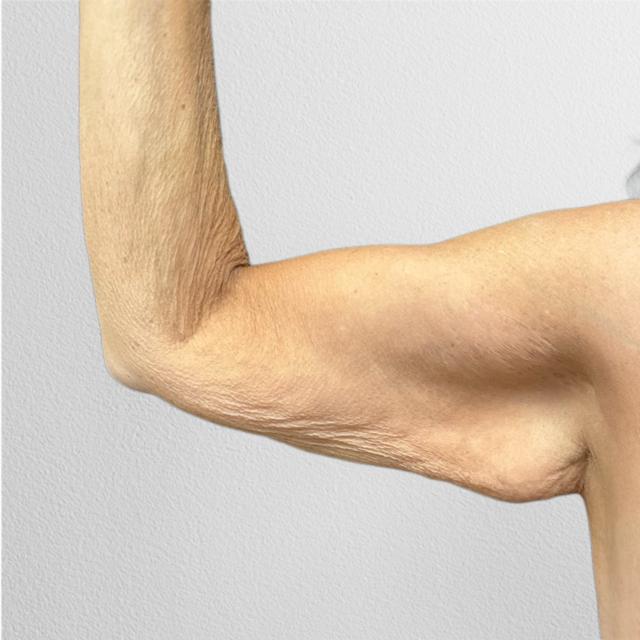 Arm Lift before at Alpine Plastic Surgery in Ogden, UT
