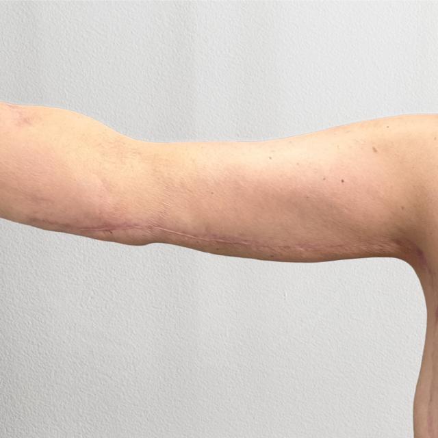 Arm Lift after at Alpine Plastic Surgery in Ogden, UT