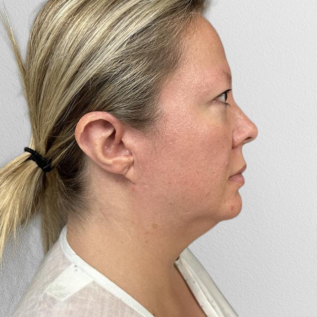 Neck Liposuction before at Alpine Plastic Surgery in Ogden, UT