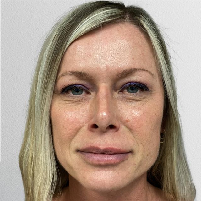 Ethnic Rhinoplasty after at Alpine Plastic Surgery in Ogden, UT