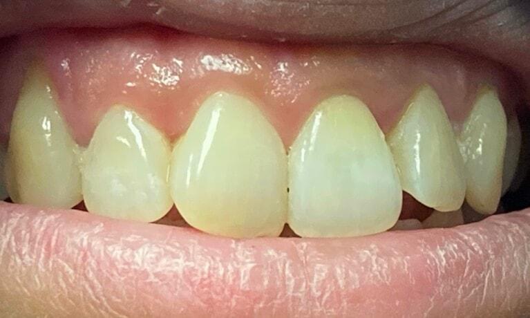 Serene Dentistry of North Salt Lake teeth whitening after — North Salt Lake, UT
