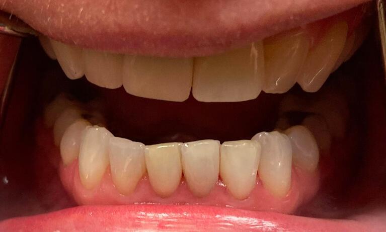 Serene Dentistry of North Salt Lake veneers after — North Salt Lake, UT