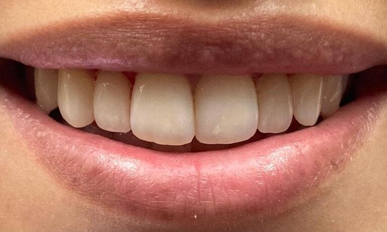 Serene Dentistry of North Salt Lake veneers after — North Salt Lake, UT
