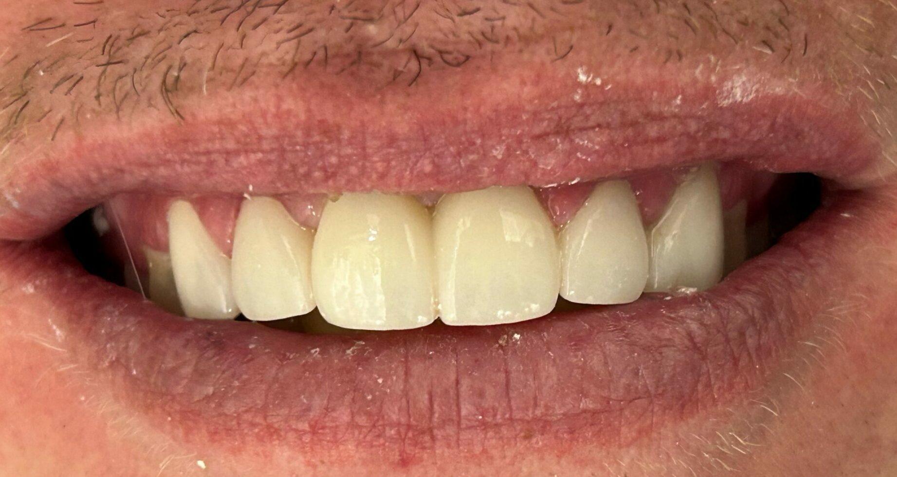 Serene Dentistry of North Salt Lake veneers after — North Salt Lake, UT