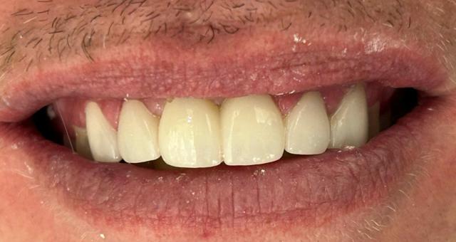 Dental Veneers after at Serene Dentistry of North Salt Lake in North Salt Lake, UT