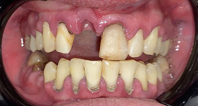 Dental Veneers before at Serene Dentistry of North Salt Lake in North Salt Lake, UT