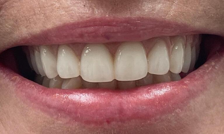 Serene Dentistry of North Salt Lake veneers after — North Salt Lake, UT