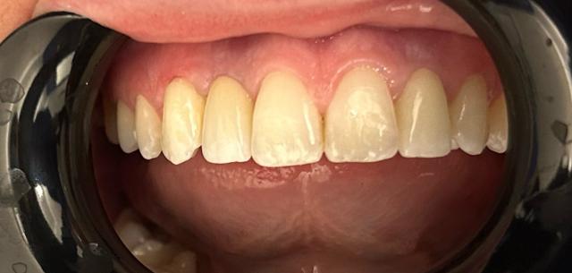 Dental Crowns after at Serene Dentistry of North Salt Lake in North Salt Lake, UT
